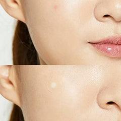 Illumiel Acne Spot patch